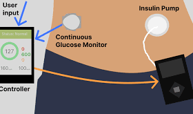 From Fantasy to Reality : The artificial pancreas Revolution